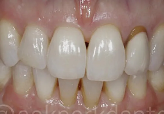 Close-up of human teeth showing slight yellowing and gum health details in a dental image.