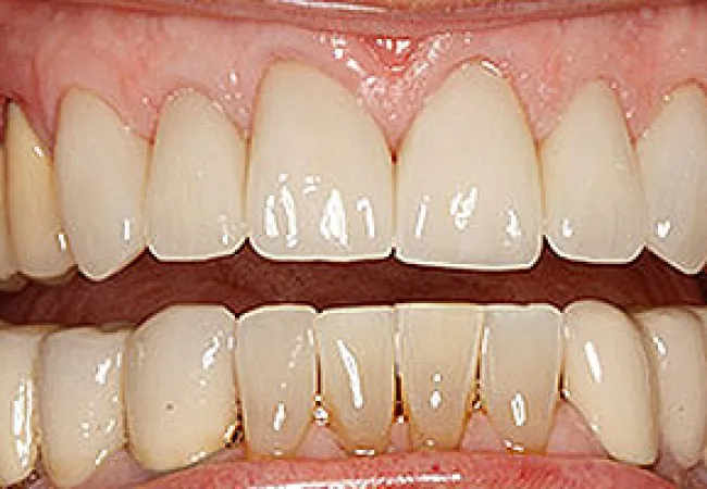 Close-up of upper and lower teeth showing dental crowns and yellowing on natural teeth.