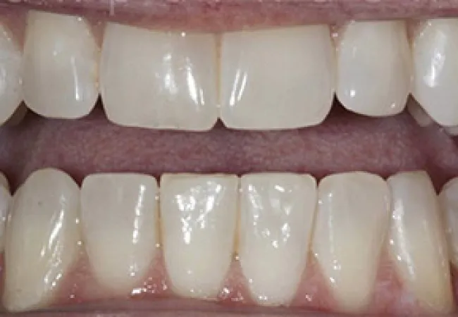 Close-up of healthy natural upper and lower teeth with slight gaps and smooth texture under bright lighting