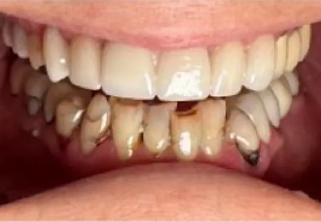 Close-up of a smile showing healthy upper teeth and severely decayed lower teeth with cavities.