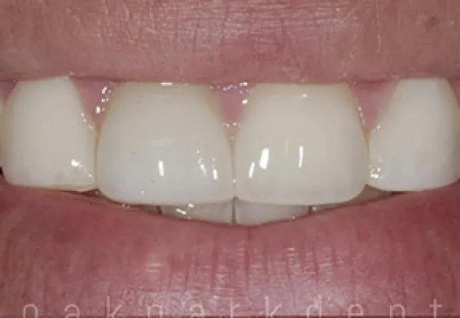 Close-up of a person's smiling mouth showing clean, white teeth and natural lips.