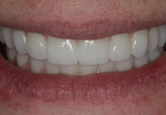 Close-up of a bright, white smile with clean teeth and natural lips in soft lighting.