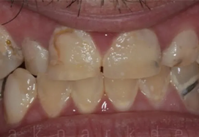 Close-up of stained, chipped, and misaligned teeth with dental decay and damage visible.