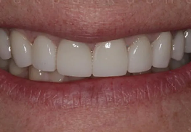 Close-up of a smiling mouth with clean, white, evenly spaced teeth and natural lips.