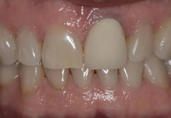 Close-up of front teeth showing a dental crown on one central incisor among natural teeth.