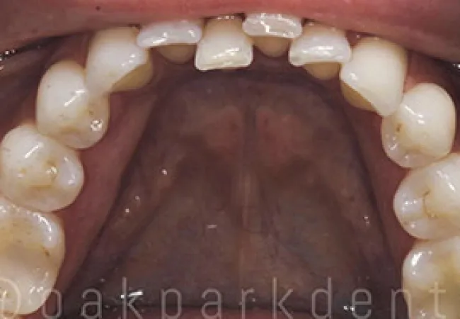 Close-up of upper teeth showing dental alignment and oral cavity details with molars and incisors.