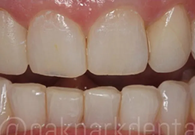 Close-up of upper and lower teeth showing natural dental alignment and coloration with healthy gums.