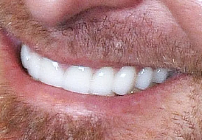 Close-up of a smiling man's mouth showing clean white teeth and facial stubble.