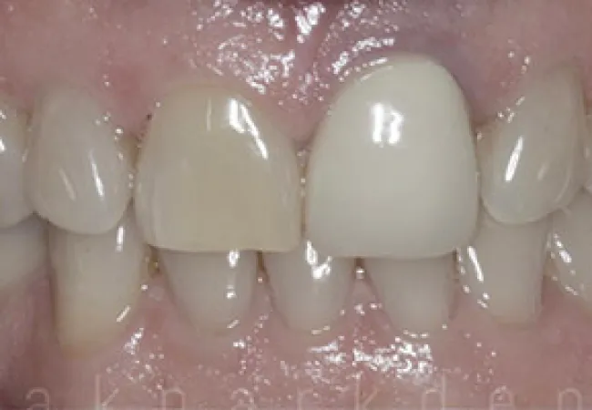 Close-up of upper front teeth showing color difference between natural teeth and a dental crown