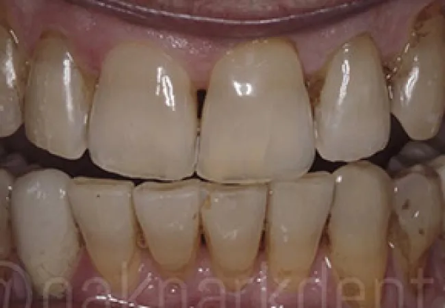 Close-up of stained and misaligned teeth with visible plaque and gum discoloration in upper and lower jaws