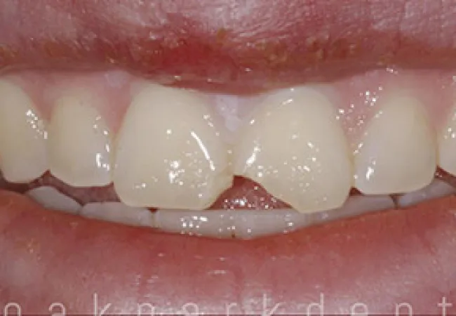 Close-up of a smile with a chipped front tooth and visible lips.