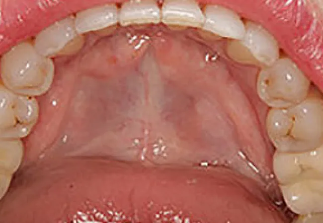 Close-up of an open mouth showing upper teeth and palate with natural tooth color and structure.