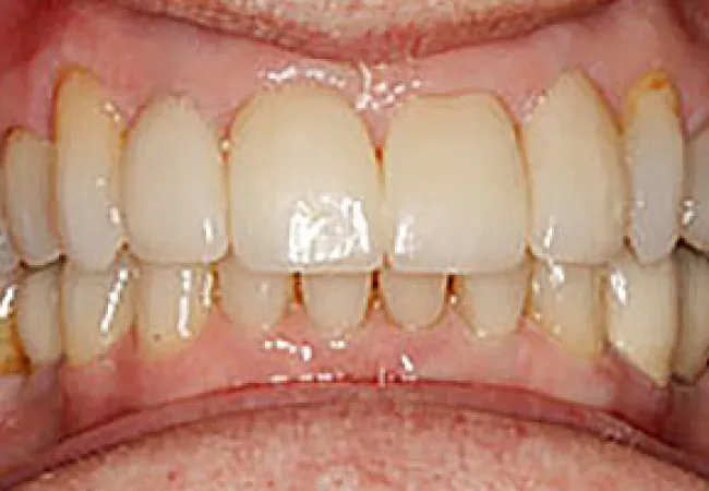 Close-up of imperfect human teeth showing discoloration and plaque along gums and between teeth.