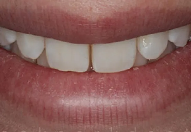 Close-up of a smile showing natural white teeth and lips with a small gap between front teeth.