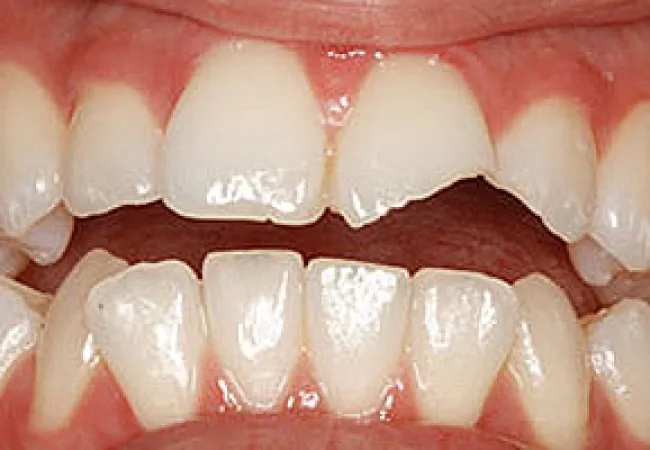 Close-up of broken upper front tooth with visible dental damage and surrounding healthy teeth and gums