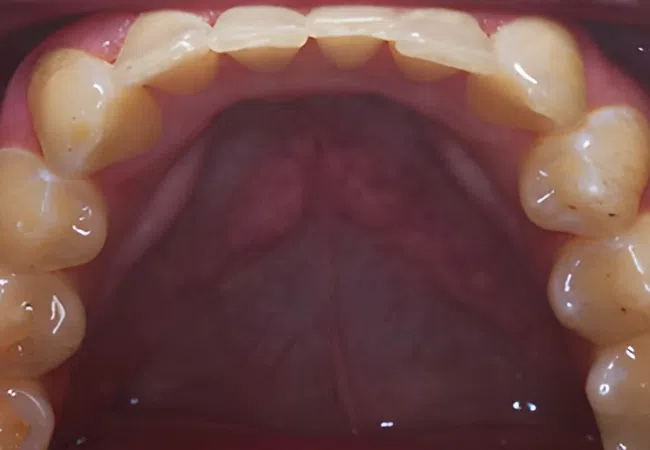 Close-up of upper teeth and gums showing natural tooth alignment and oral cavity details.