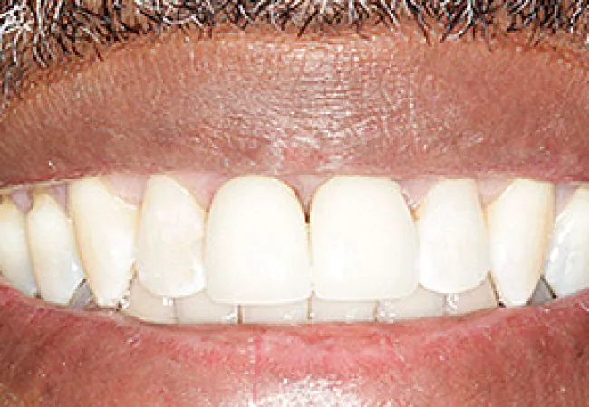 Close-up of a smiling mouth with clean, evenly aligned white teeth and facial stubble.