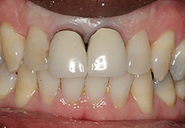Close-up of human teeth showing dental crowns on upper front teeth with natural gums visible.