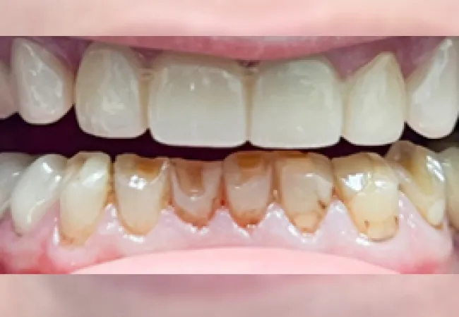 Close-up of teeth showing severe staining and discoloration on lower front teeth with healthy upper teeth.
