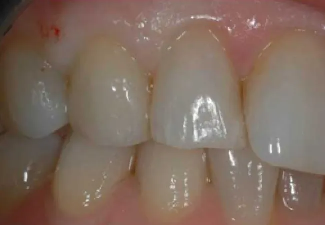 Close-up of upper and lower human teeth showing clean and healthy gums and enamel surface.