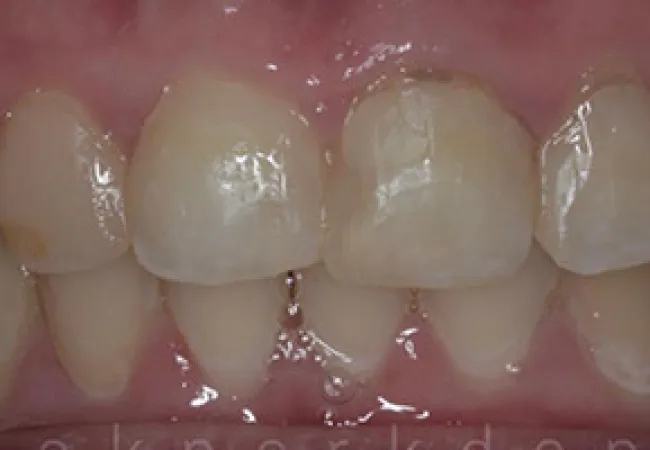 Close-up of upper and lower front teeth showing dental plaque and slight discoloration on some teeth.