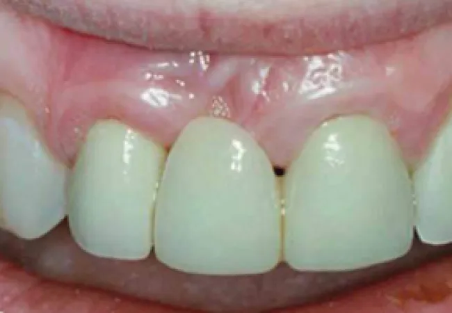 Close-up of upper front teeth with a missing central incisor revealing gum tissue area.