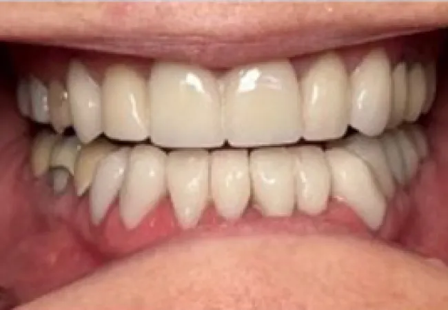 Close-up of a mouth showcasing natural teeth and dental crowns in upper and lower jaws.
