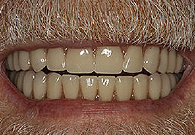 Close-up of an elderly person's mouth showing aged, yellowed teeth and a mustache.