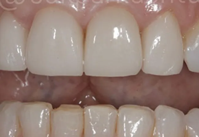 Close-up of human teeth showing upper front dental crowns and lower natural teeth with some wear.