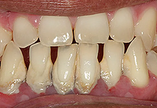 Close-up of crooked, stained teeth with visible plaque and gum inflammation, showing poor dental health.