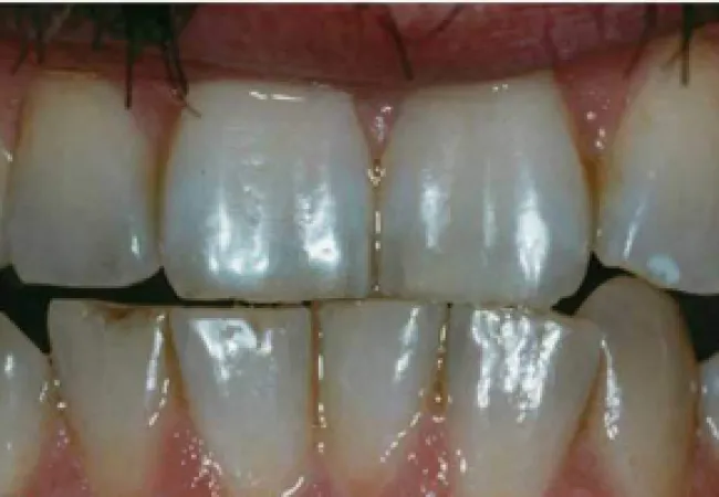 Close-up of stained and damaged front teeth with gaps and discoloration on upper and lower jaws.