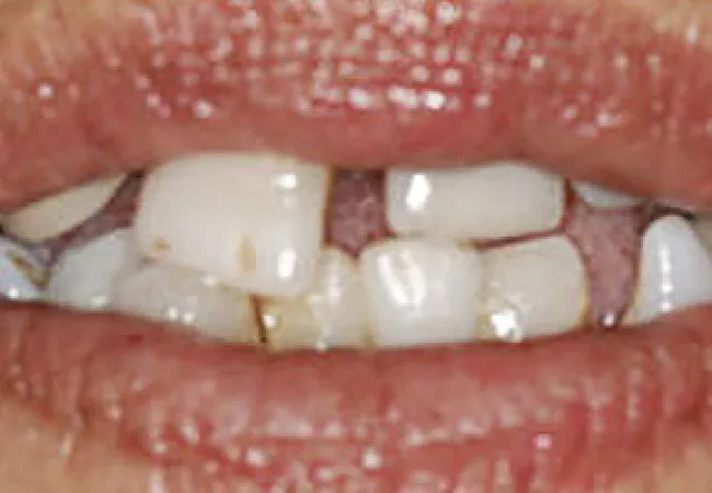 Close-up of teeth with severe misalignment, discoloration, and dental decay on upper and lower teeth.