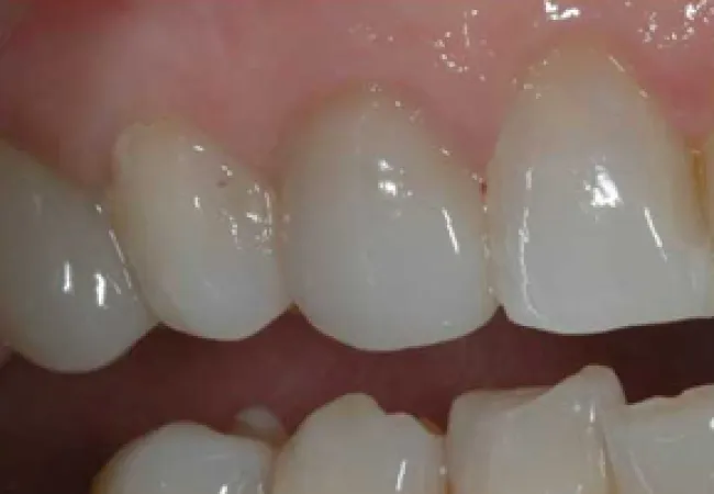 Close-up of clean, natural upper and lower teeth with a small gap between the front teeth
