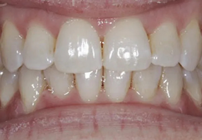 Close-up of healthy human teeth with visible gums and slightly open mouth showing upper and lower teeth.