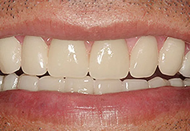 Close-up of a smiling mouth showing clean, white upper and lower teeth with natural lips and skin texture.