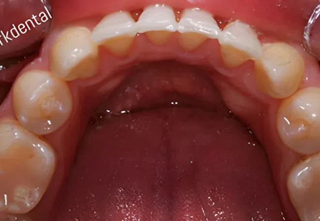 Close-up of upper teeth and gums inside a mouth showing dental anatomy and oral hygiene.