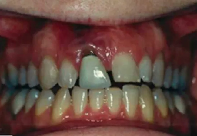 Close-up of teeth with dental implant and surrounding gums showing oral health details.