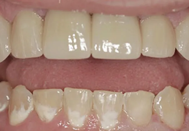 Close-up of upper and lower teeth showing dental discoloration and white spots on several teeth.