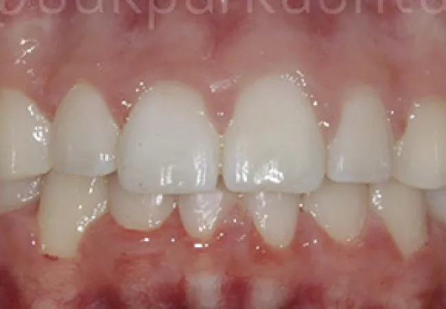 Close-up of upper and lower teeth showing mild crowding and gingival redness in a dental examination.