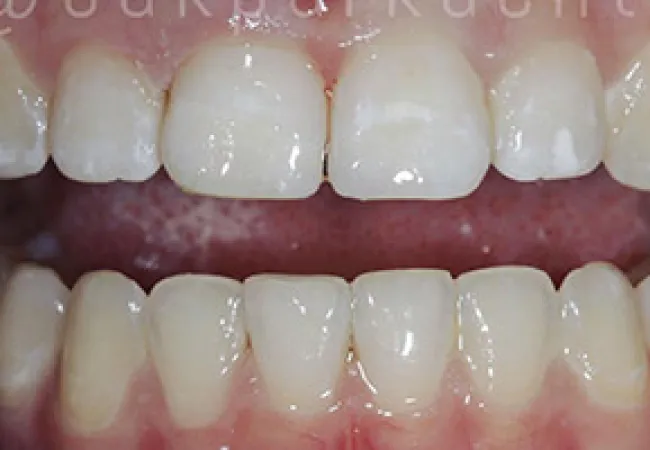 Close-up of upper and lower natural teeth showing slight gaps and healthy gums