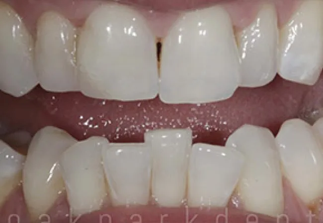 Close-up of healthy human teeth showing upper and lower front teeth with natural texture and spacing.
