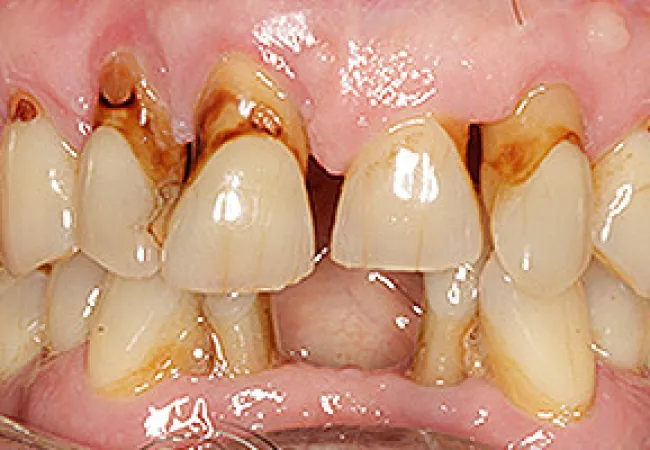 Close-up of severely decayed and discolored upper and lower teeth with visible cavities and gum inflammation.