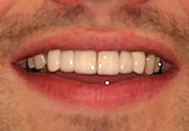 Close-up of a smiling mouth with upper front teeth and facial stubble in warm lighting.