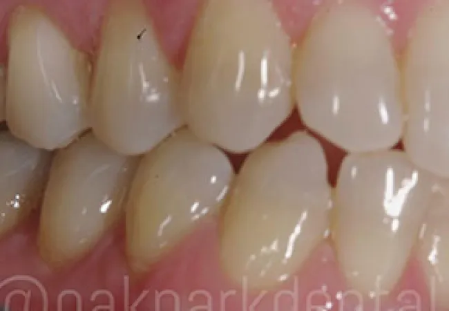 Close-up of upper and lower teeth showing dental crowding and alignment issues in the mouth.