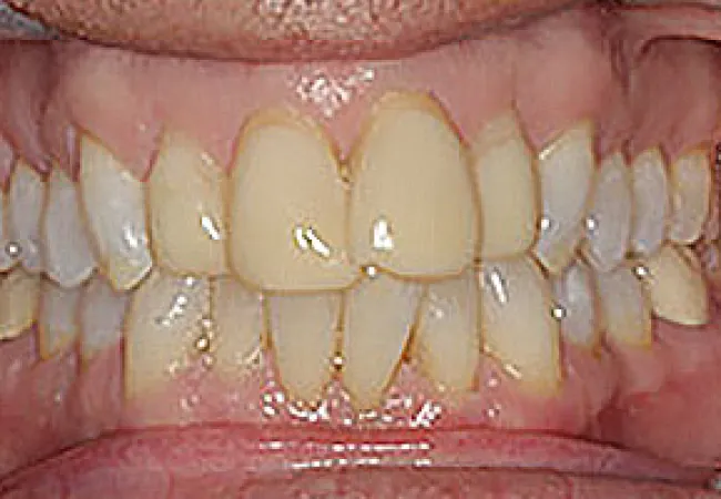 Close-up of discolored, misaligned lower and upper teeth with visible plaque and gum inflammation