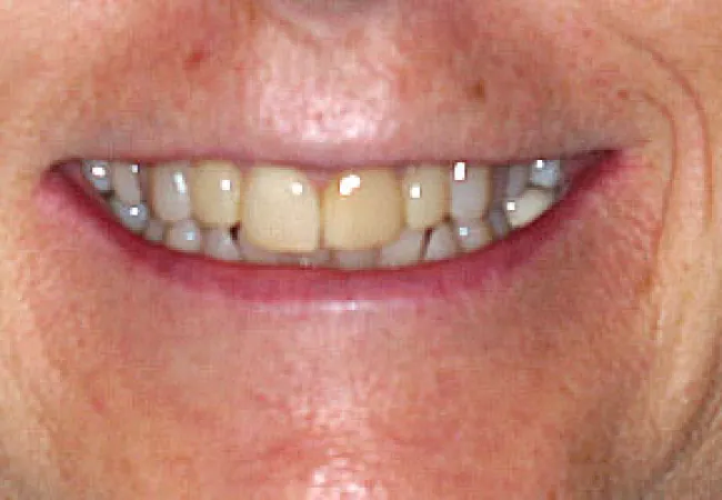 Close-up of an elderly person's smile showing natural teeth with signs of aging and discoloration.