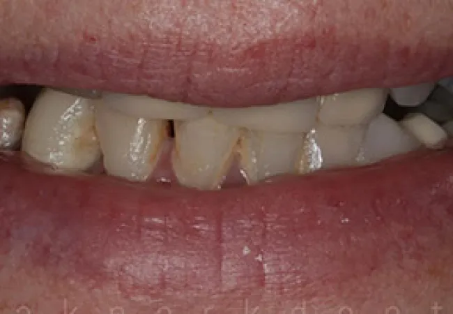 Close-up of mouth showing severely decayed and missing teeth with visible cavities and discoloration.