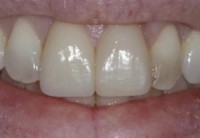 Close-up of a smile showing clean, white upper front teeth and lips with natural texture.