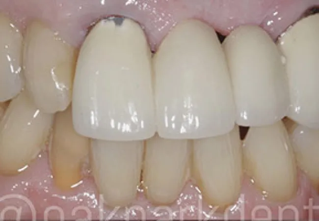 Close-up of upper and lower teeth with visible dental crowns and natural teeth, showing some discoloration and damage.