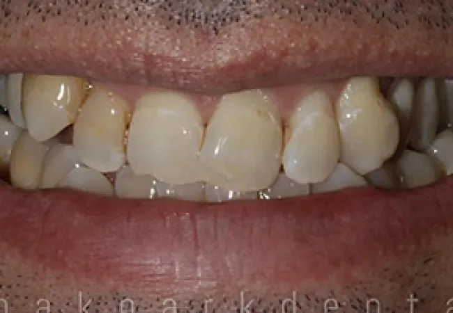 Close-up of a smile showing stained and misaligned upper teeth with visible plaque and discoloration.